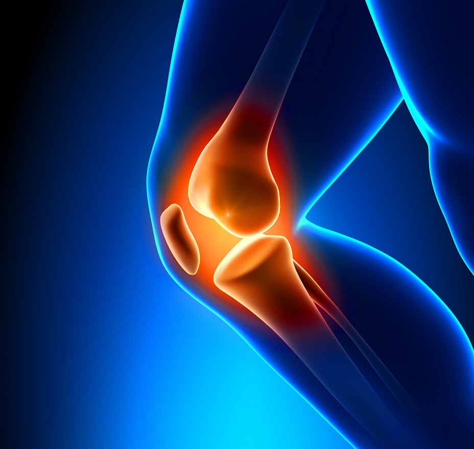 Knee replacements – one size fits all? - Barker Brettell